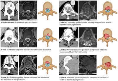 Deep learning assessment compared to radiologist reporting for metastatic spinal cord compression on CT